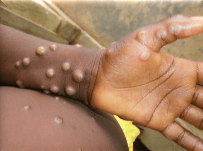 monkeypox